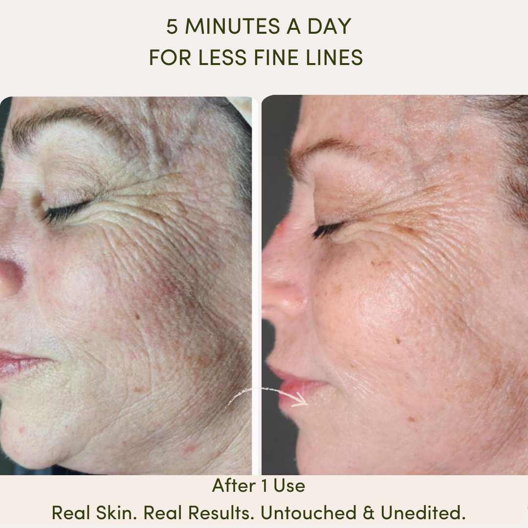 Before and after results of using Me Time Botanicals Everything Device, showing a visible reduction in fine lines and improved skin texture around the eyes and cheeks after just one use, with the tagline 'Real Skin. Real Results. Untouched & Unedited.