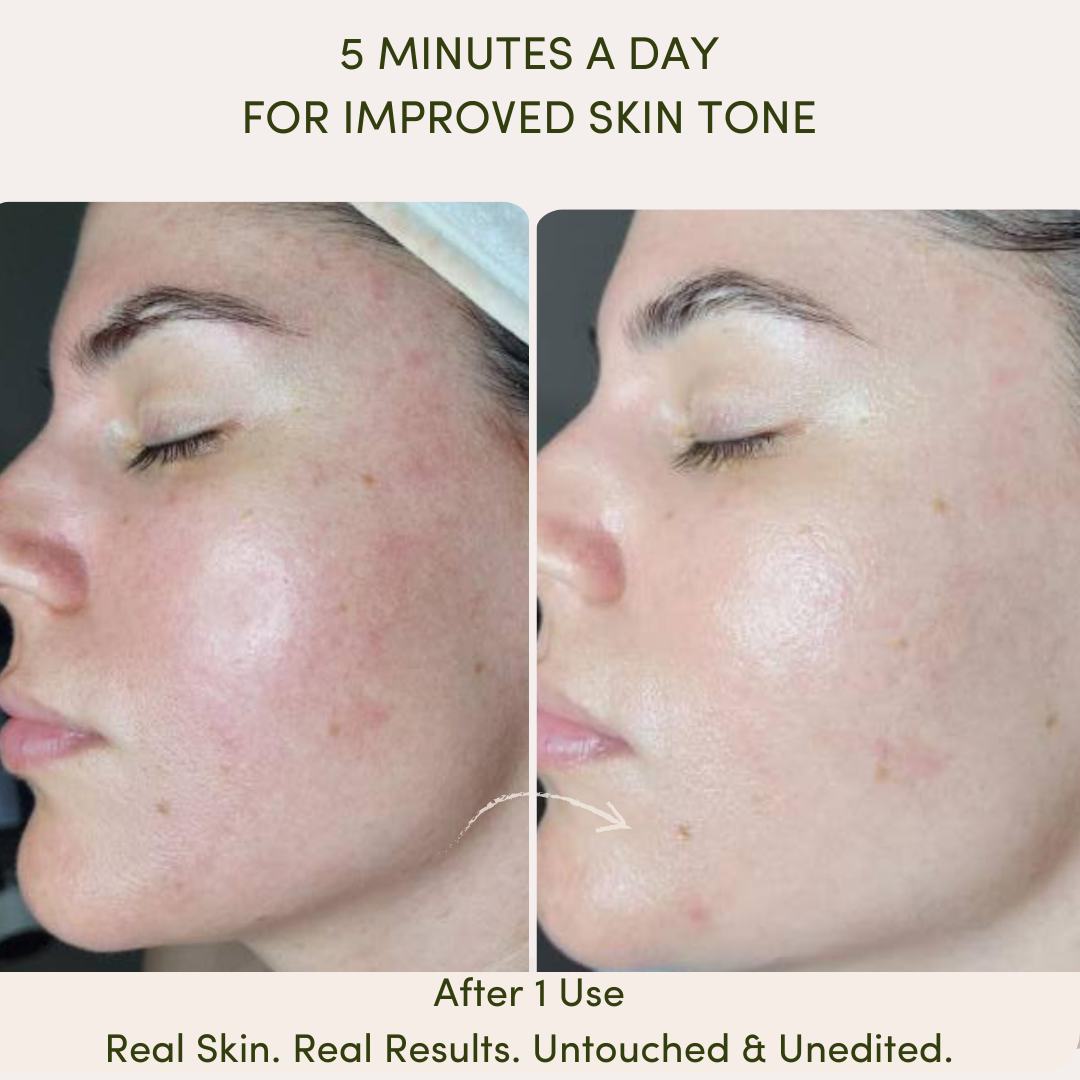 "Before and after results of using Me Time Botanicals Everything Device, showing improved skin tone, reduced redness, and a glowing complexion after just one use, with the tagline 'Real Skin. Real Results. Untouched & Unedited